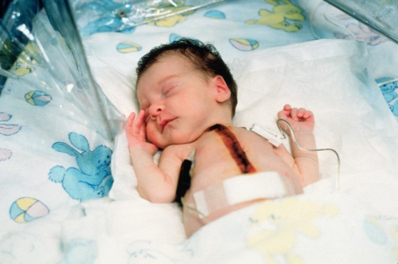 Baby Fae After Heart Transplant