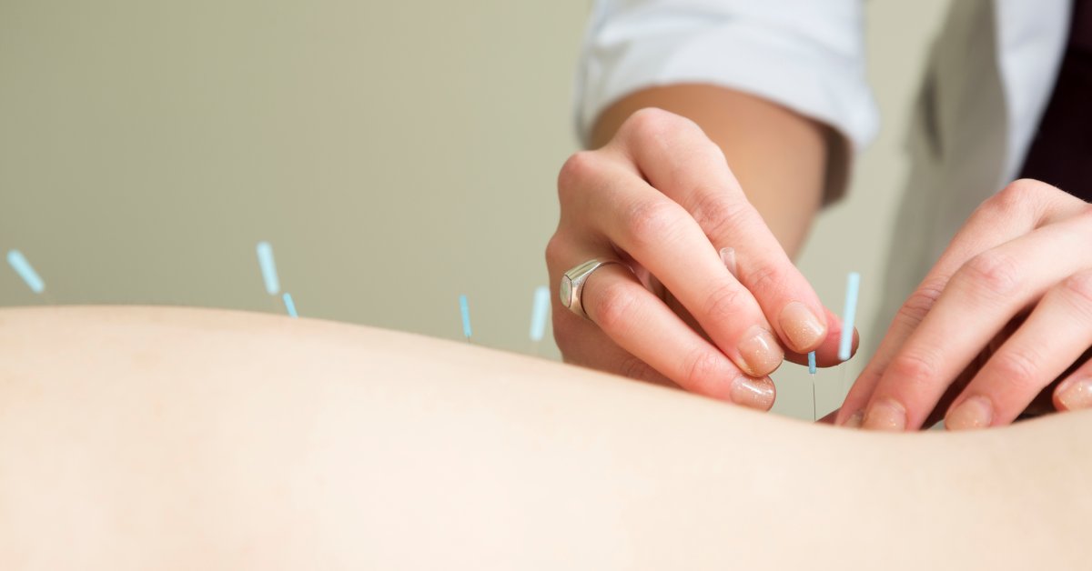 The Health Benefits of Acupuncture