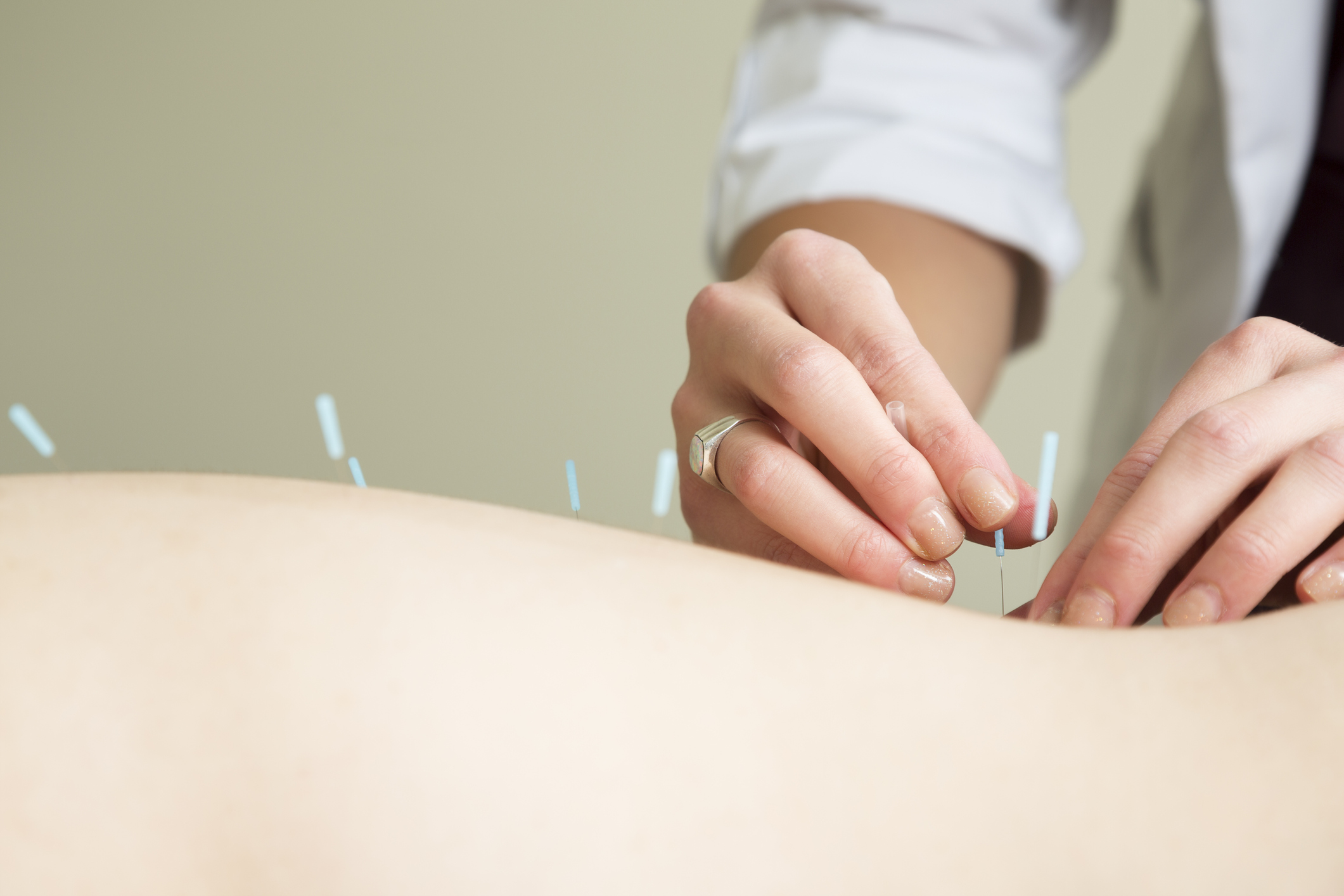 acupuncture-health-benefits