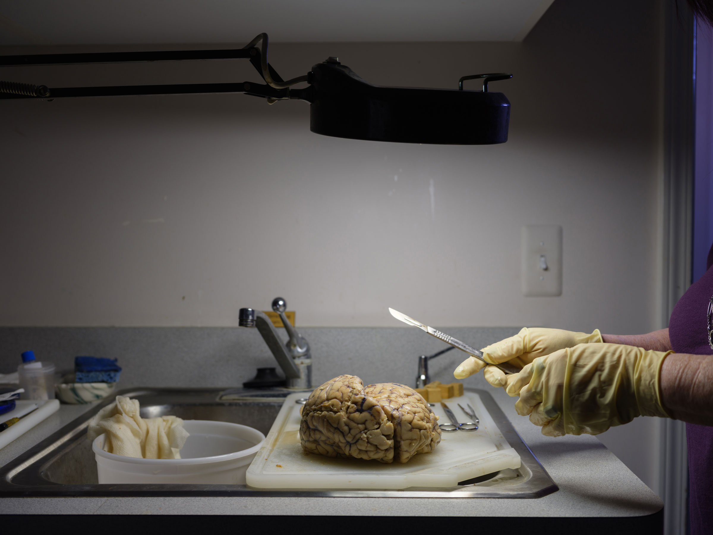 A human brain being examined after it has been fixed in formaldehyde and hardened (Jarod Lew for TIME)