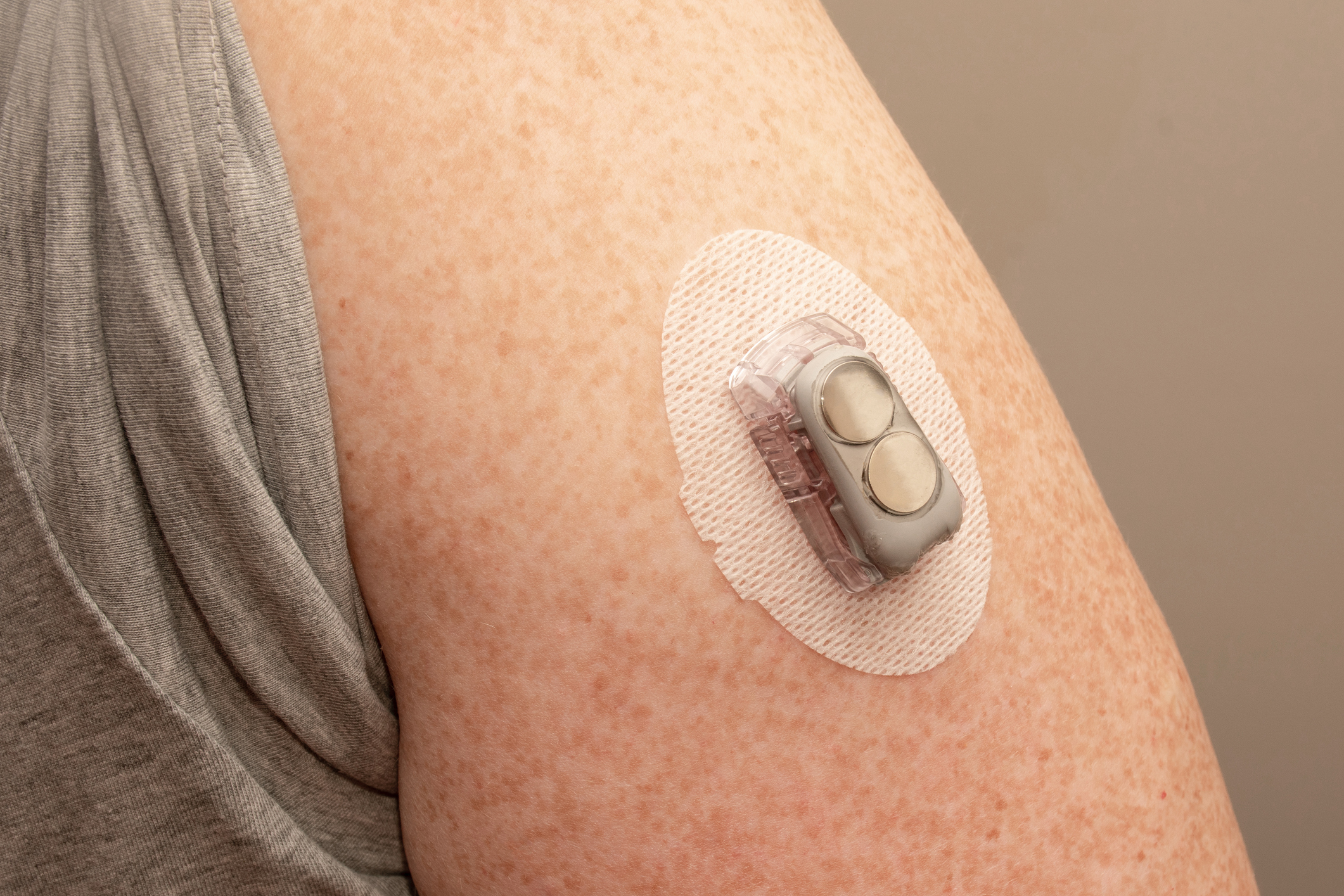 CGM - Continuous glucose monitoring: sensor installed on the upper arm. Transmitter with replaced batteries. Diabetes (Daria Nipot—
                      Getty Images)