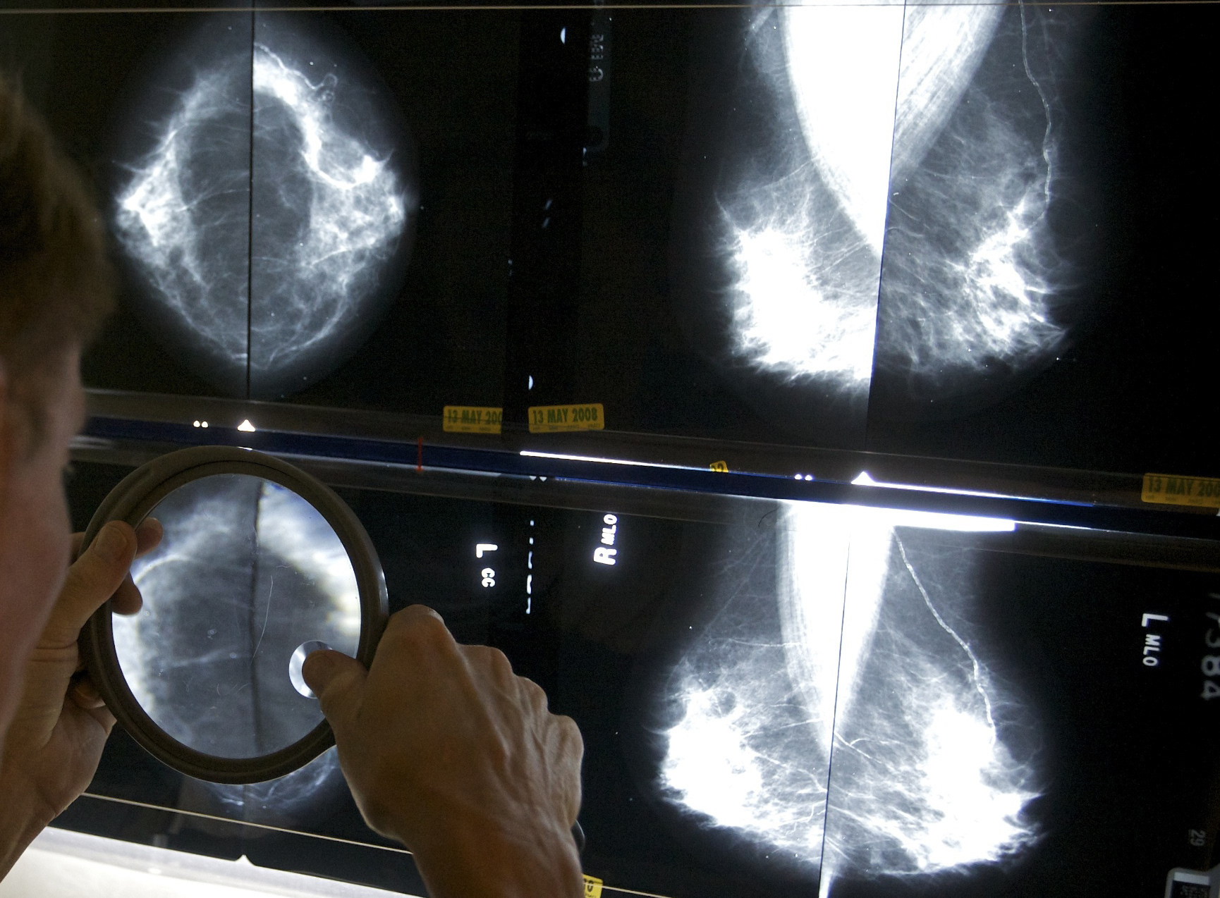 A radiologist uses a magnifying glass to check mammograms for breast cancer in Los Angeles on May 6, 2010. U.S. women getting m (Damian Dovarganes—AP Photo)