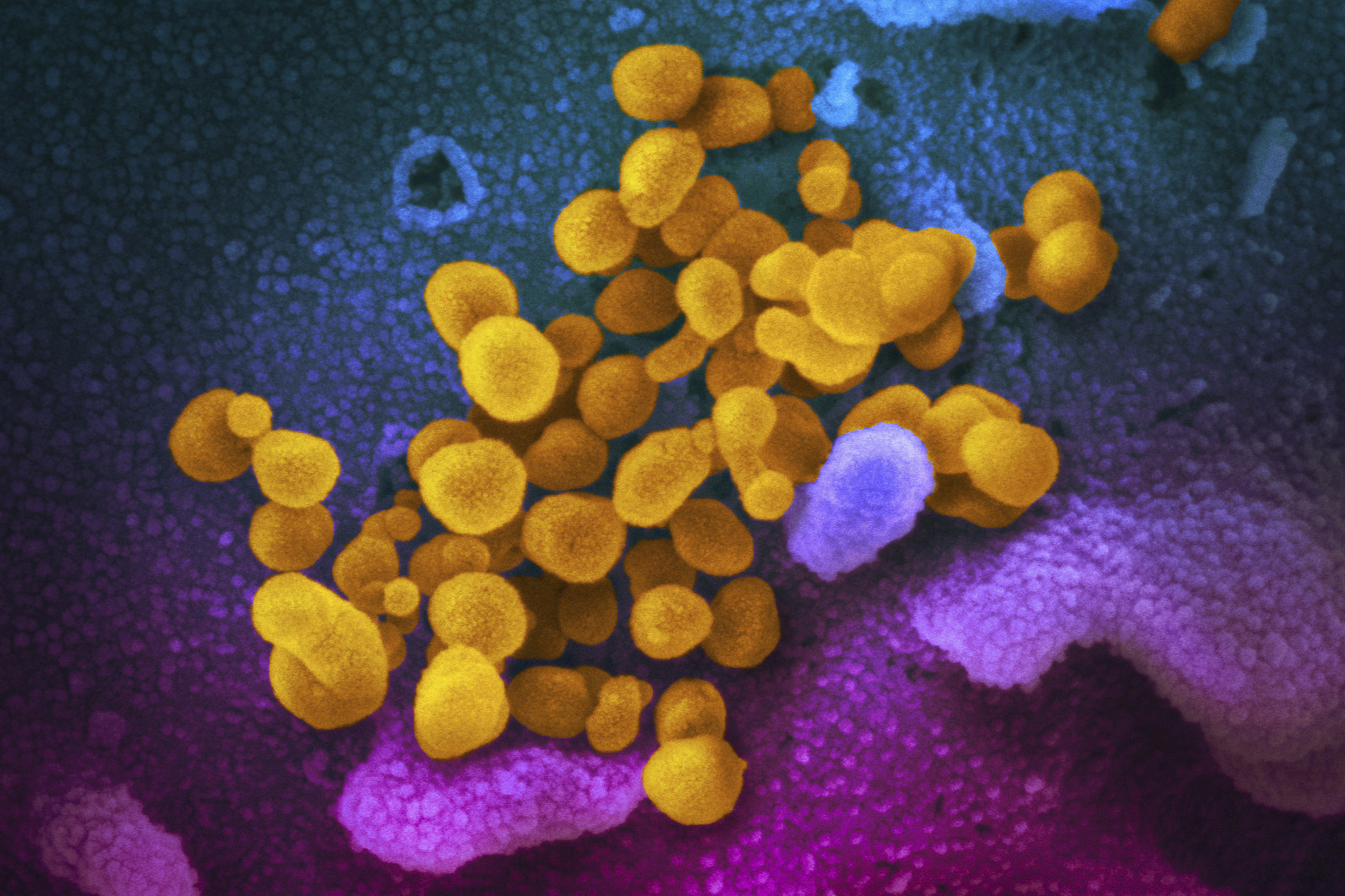This colorized electron microscope image made available by the U.S. National Institutes of Health in February 2020 shows SARS-CoV-2, indicated in yellow, emerging from the surface of cells, indicated in blue/pink, cultured in a laboratory. The sample was isolated (NIAID-RML—AP)