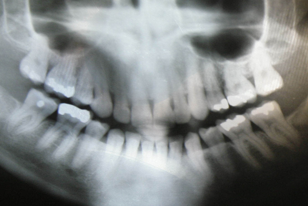 dental-x-ray-lead-apron