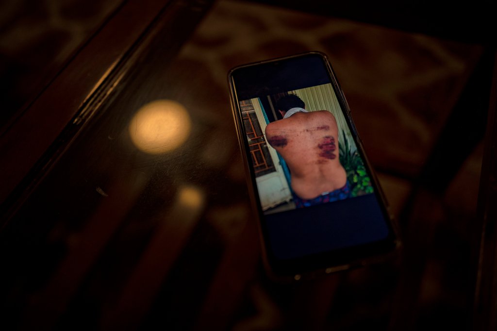 A photo showing bruises a Filipino national sustained while in detention in Cambodia is displayed on a smartphone in Manila, Philippines, on June 26, 2023.